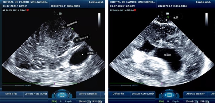 左圖顯示術(shù)中超聲見囊實性病變，大小約為4x4x3cm，病灶周圍腦組織水腫明顯；右圖為病灶切除后，術(shù)中超聲示術(shù)腔無病變殘留