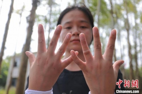 吳素英展示被蜜蜂蜇過的雙手。湯曉逵 攝