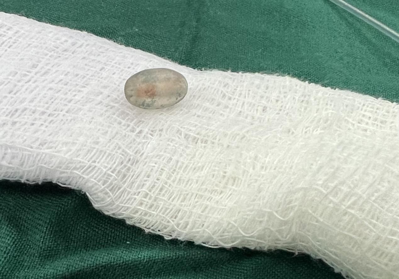 被取出的異物。中國(guó)援桑醫(yī)療隊(duì)供圖