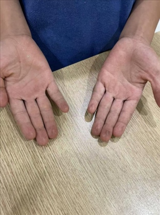 9歲小學(xué)生長期拍煙卡，手部粗糙長繭。受訪者供圖