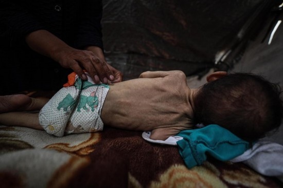 這是5月28日在加沙城西部一處臨時安置點(diǎn)拍攝的一名營養(yǎng)不良的嬰兒。新華社發(fā)（馬哈茂德·扎基攝）